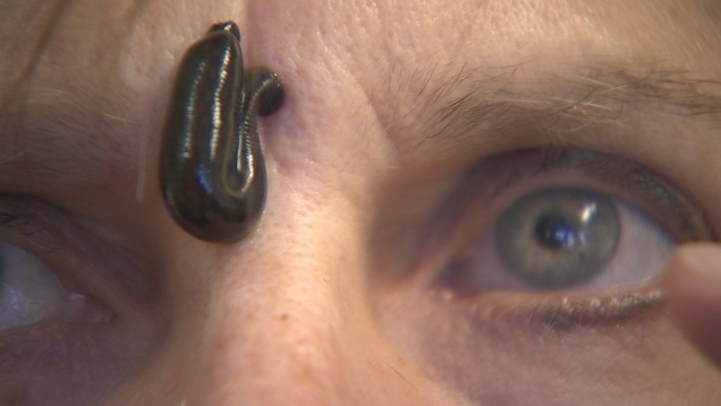 What To Do When Leeches Bite You at Angela Correa blog